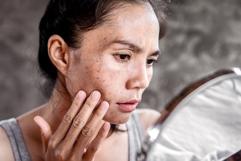 Woman touching dark spots on her face